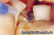 нанесение протравочного геля на зуб