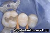 Художественная реставрация зубов