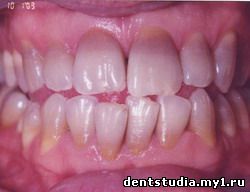 Татрациклиновые зубы до профессионального отбеливания