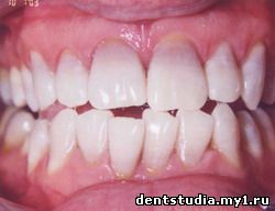 Тетрациклиновые зубы после профессионального отбеливания