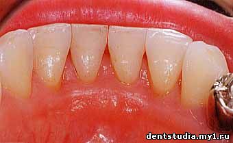 зубные камни после чистки