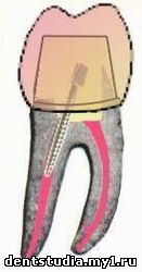 установка коронки на вылеченный зуб