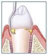 Зубной камень на поверхности зуба