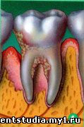 зубной камень- наддесневой и поддесневой