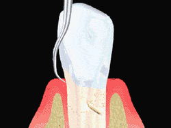 удаление зубных камней